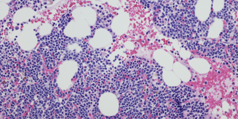 multiple myeloma cells