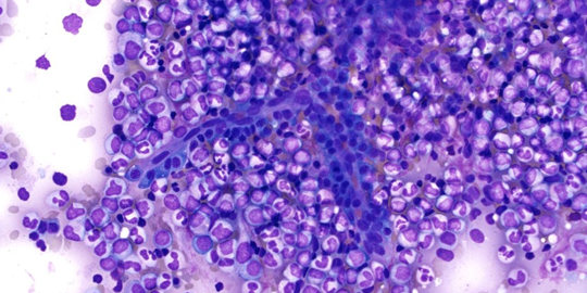 myeloma cells