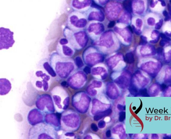 Myeloma Cells Under Microscope