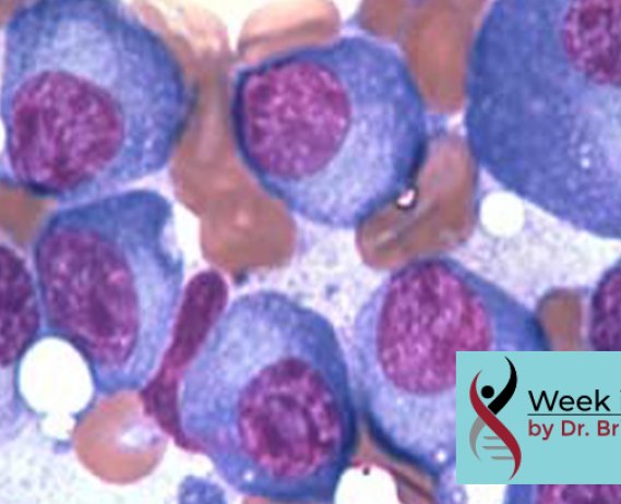 Multiple myeloma cells under microscope